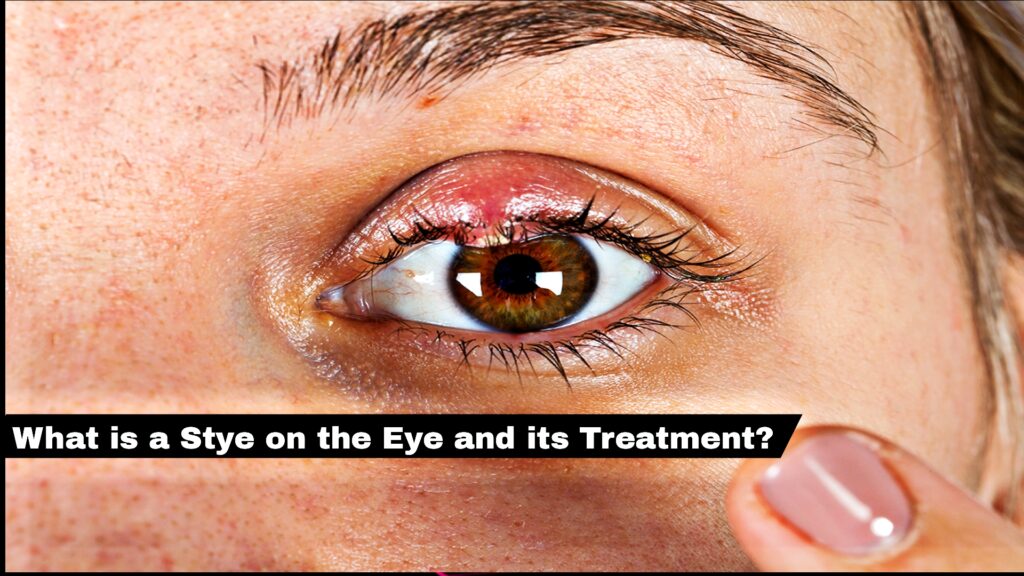 What is a Stye on the Eye and its Treatment?