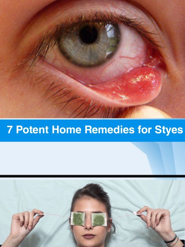 7 Potent Home Remedies for Styes